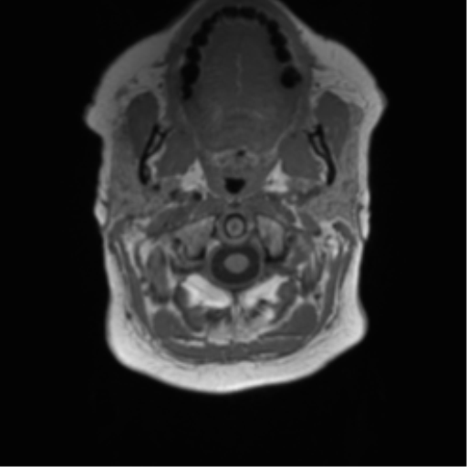 File:Anaplastic oligodendroglioma (Radiopaedia 83500-98599 Axial T1 2).png