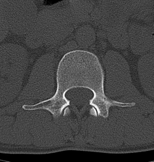 Aneurysmal bone cyst T11 (Radiopaedia 29294-29721 Axial bone window 74).jpg