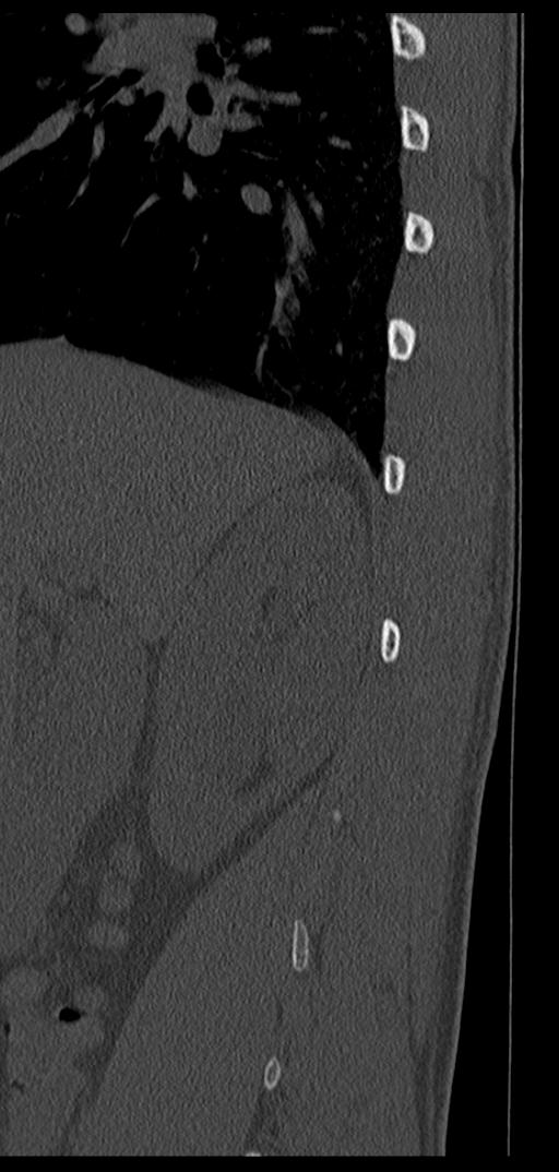 Aneurysmal bone cyst T11 (Radiopaedia 29294-29721 Sagittal bone window 72).jpg