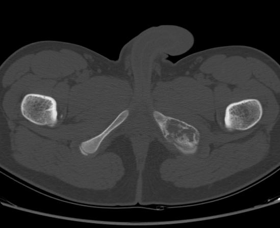 File:Aneurysmal bone cyst of ischium (Radiopaedia 25957-26094 Axial bone window 78).png
