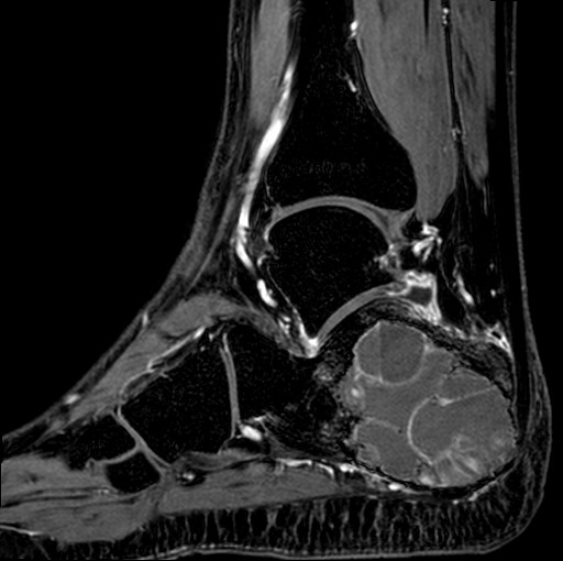 File:Aneurysmal bone cyst of the calcaneus (Radiopaedia 60669-68420 F 16).jpg