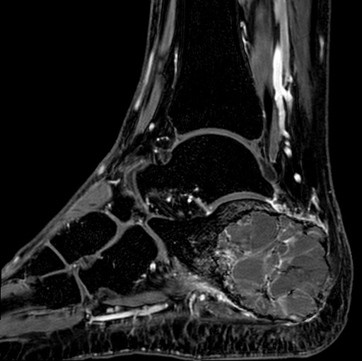 File:Aneurysmal bone cyst of the calcaneus (Radiopaedia 60669-68420 F 25).jpg