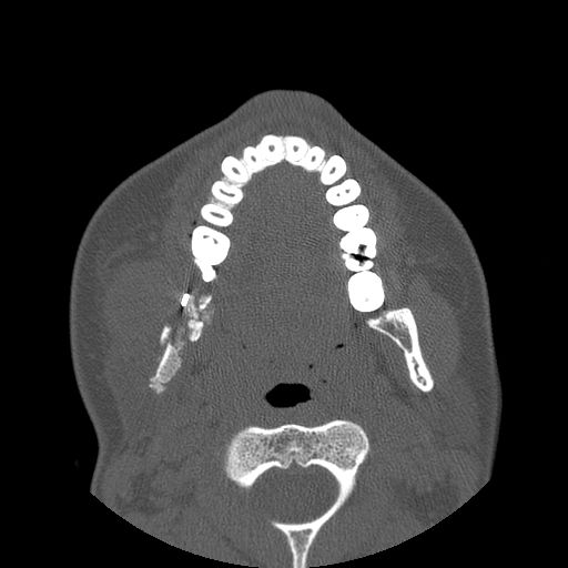 File:Aneurysmal bone cyst of the mandible (Radiopaedia 43280-46823 Axial bone window 71).jpg