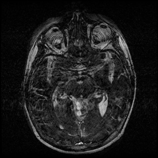 Angioinvasive aspergillosis in the pituitary fossa (Radiopaedia 39676-42010 Ax 3D FIESTA VOLUME 75).png