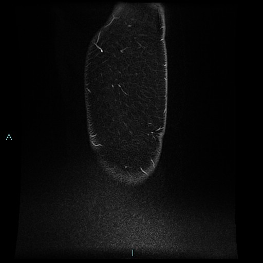 Angioleiomyoma (Radiopaedia 85442-101078 F 14).jpg