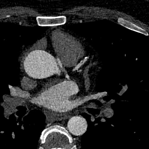 File:Anomalous origin of the left coronary artery with malignant course (Radiopaedia 77842-90126 C 26).jpeg