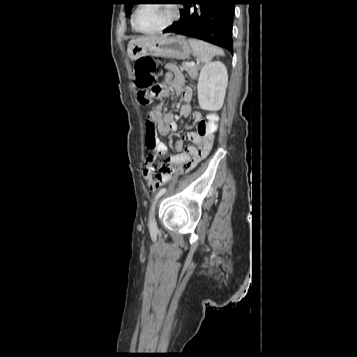 Anorectal carcinoma (Radiopaedia 44413-48064 C 82).jpg