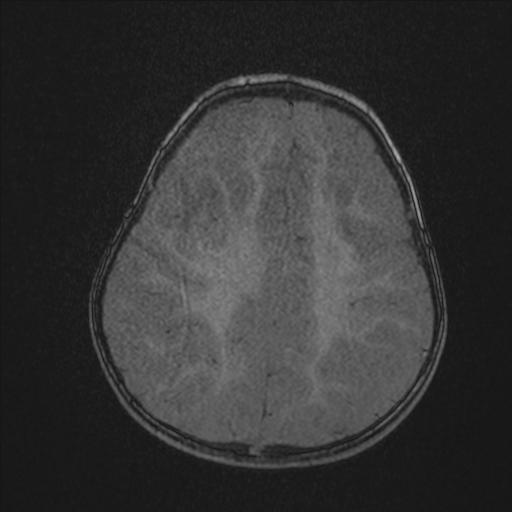 Anoxic brain injury (Radiopaedia 79165-92139 Axial MRA 190).jpg