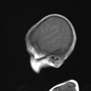 File:Anoxic brain injury (Radiopaedia 79165-92139 Sagittal T1 4).jpg