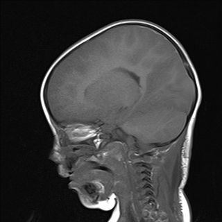 File:Anoxic brain injury (Radiopaedia 79165-92139 Sagittal T1 9).jpg