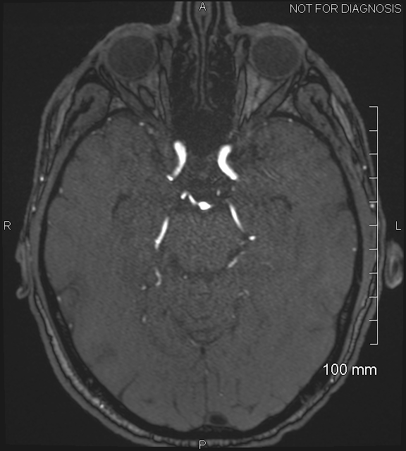 Anterior cerebral artery aneurysm (Radiopaedia 80683-94127 Axial MRA 90).jpg