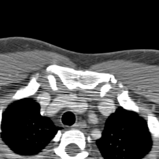 File:Anterior cerebral artery territory infarct (Radiopaedia 39327-41581 B 105).png