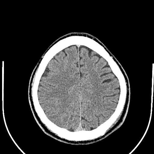 Anterior choroidal artery infarct (Radiopaedia 55106-61480 Axial non-contrast 45).jpg