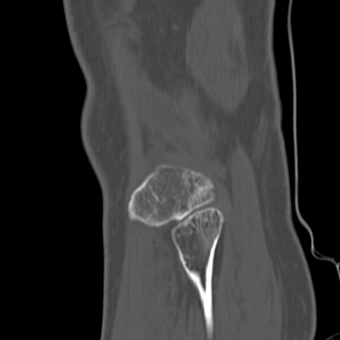 File:Anterior cruciate ligament avulsion fracture (Radiopaedia 58939-66194 Sagittal bone window 3).jpg