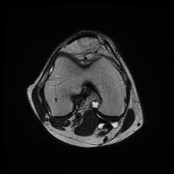 File:Anterior cruciate ligament graft tear and bucket-handle tear of medial meniscus (Radiopaedia 75867-87254 Axial T2 14).jpg