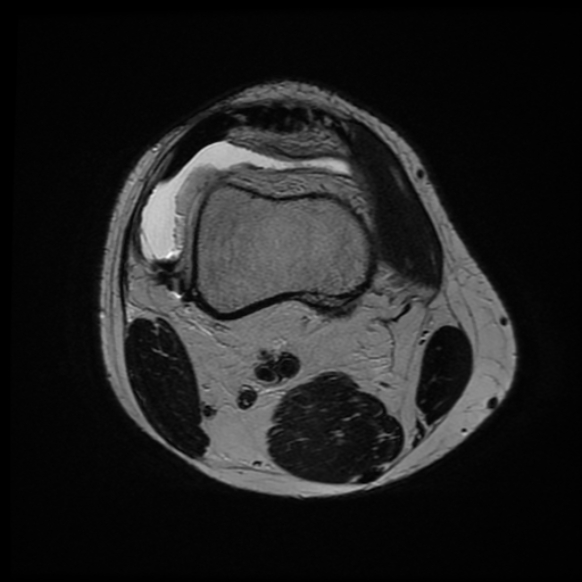 File:Anterior cruciate ligament graft tear and bucket-handle tear of medial meniscus (Radiopaedia 75867-87255 Axial T2 22).jpg