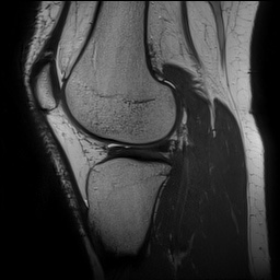 Anterior cruciate ligament rupture and posteromedial corner injury (Radiopaedia 67338-76723 Sagittal PD 112).jpg