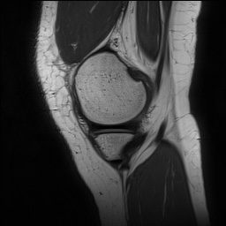 Anterior cruciate ligament rupture and posteromedial corner injury (Radiopaedia 67338-76723 Sagittal PD 38).jpg