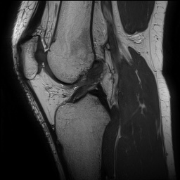 Anterior cruciate ligament rupture and posteromedial corner injury (Radiopaedia 67338-76723 Sagittal PD 90).jpg