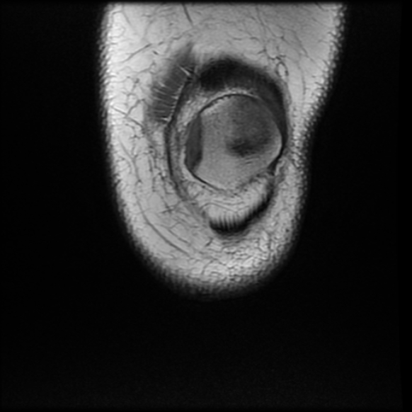 File:Anterior cruciate ligament tear, Wrisberg rip and bucket-handle tear of medial meniscus (Radiopaedia 75872-87266 Coronal T1 4).jpg