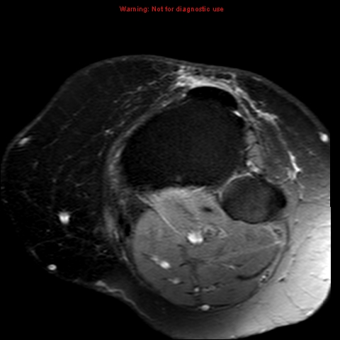 File:Anterior cruciate ligament tear (Radiopaedia 12329-12612 Axial T2 fat sat 3).jpg