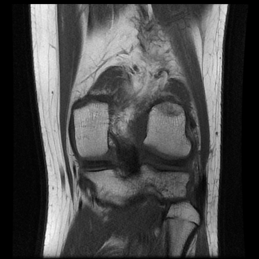 File:Anterior cruciate ligament tear (Radiopaedia 61500-69462 Coronal T1 15).jpg