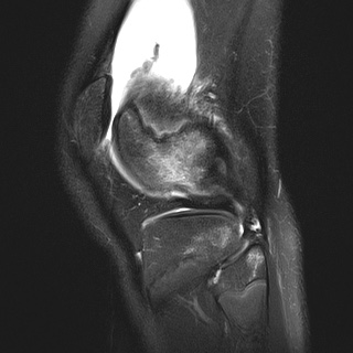 File:Anterior cruciate ligament tear - pediatric (Radiopaedia 62152-70260 Sagittal PD fat sat 29).jpg