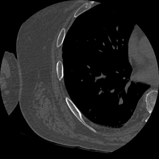 Anterior glenohumeral dislocation with Hill-Sachs lesion (Radiopaedia 62877-71249 Axial bone window 112).jpg