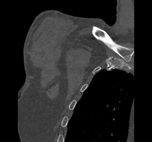 Anterior glenohumeral dislocation with Hill-Sachs lesion (Radiopaedia 62877-71249 Coronal bone window 2).jpg