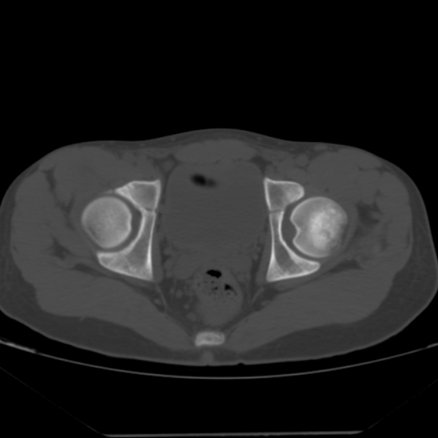 Anterior inferior iliac spine avulsion fracture (Radiopaedia 49469-54627 Axial bone window 39).jpg
