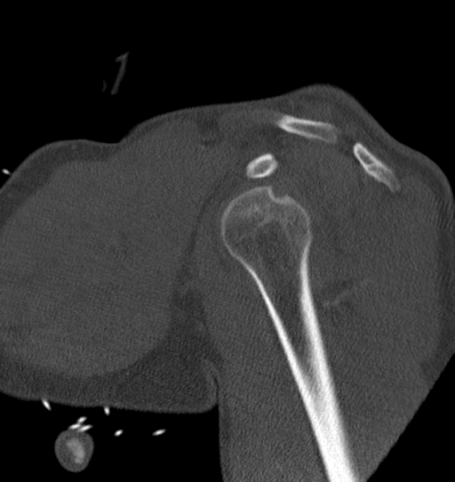 Anterior shoulder dislocation with Hill-Sachs and bony Bankart lesions (Radiopaedia 40424-42974 Sagittal bone window 22).png