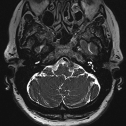 Anterior temporal pole cysts (Radiopaedia 46629-51102 Axial T2 23).png