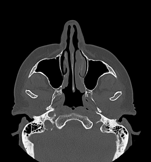 Anterior temporomandibular joint dislocation (Radiopaedia 59430-66784 Axial non-contrast 17).jpg