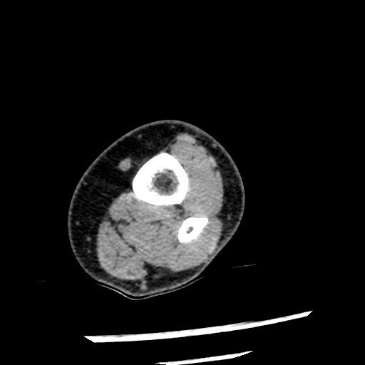 File:Anterior tibial artery false aneurysm (Radiopaedia 88984-105809 A 22).jpg