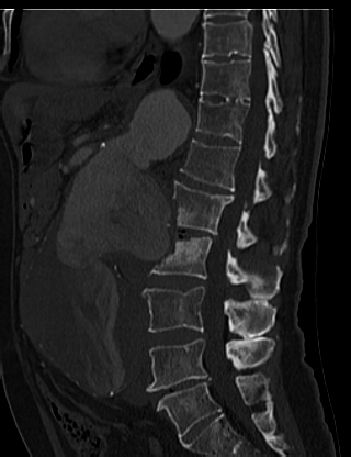 File:Anterior vertebral scalloping (abdominal aortic aneurysm) (Radiopaedia 66744-76067 Sagittal bone window 40).jpg