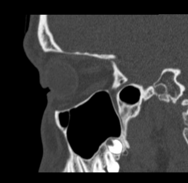Antrochoanal polyp (Radiopaedia 33984-35202 Sagittal bone window 61).jpg