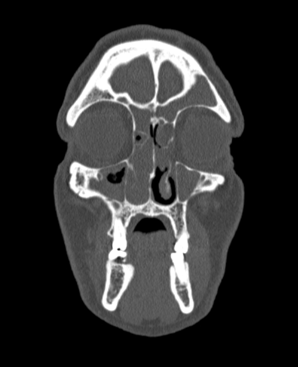 Antrochoanal polyp (Radiopaedia 79011-92169 Coronal bone window 66).jpg