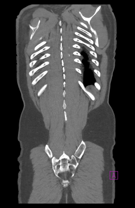 Aortectomy and axillary-bifemoral bypass (Radiopaedia 28303-28545 C 82).jpg