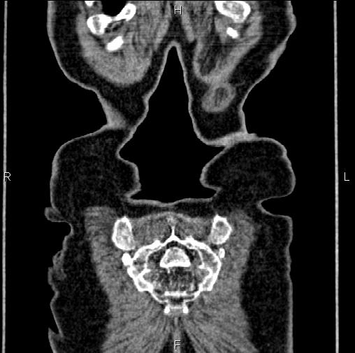 Aortic aneurysm and Lemmel syndrome (Radiopaedia 86499-102554 C 66).jpg