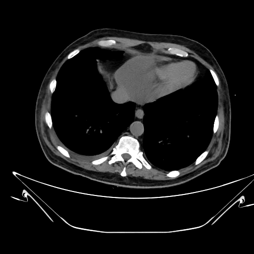 Aortic arch aneurysm (Radiopaedia 84109-99365 Axial non-contrast 219).jpg