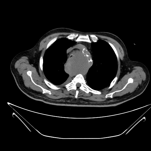 Aortic arch aneurysm (Radiopaedia 84109-99365 Axial non-contrast 78).jpg
