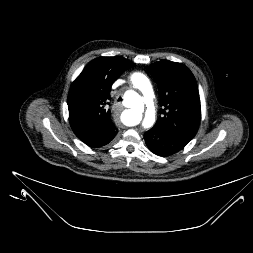 Aortic arch aneurysm (Radiopaedia 84109-99365 B 223).jpg