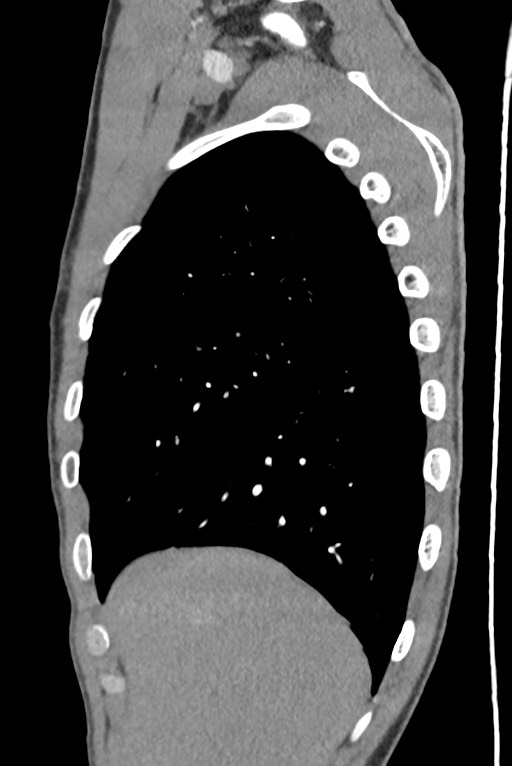Aortic coarctation with aneurysm (Radiopaedia 74818-85828 B 35).jpg