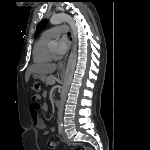 File:Aortic dissection- Stanford A (Radiopaedia 37759-39664 Sagittal C+ delayed 19).png