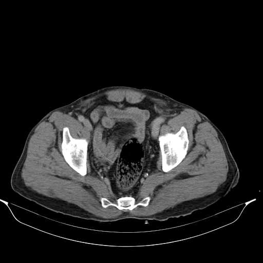 File:Aortic dissection- Stanford type A (Radiopaedia 22085-22085 Axial C+ delayed 47).jpg