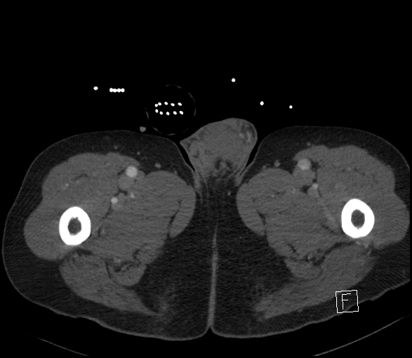 Aortic dissection (CTPA) (Radiopaedia 75506-86750 E 182).jpg
