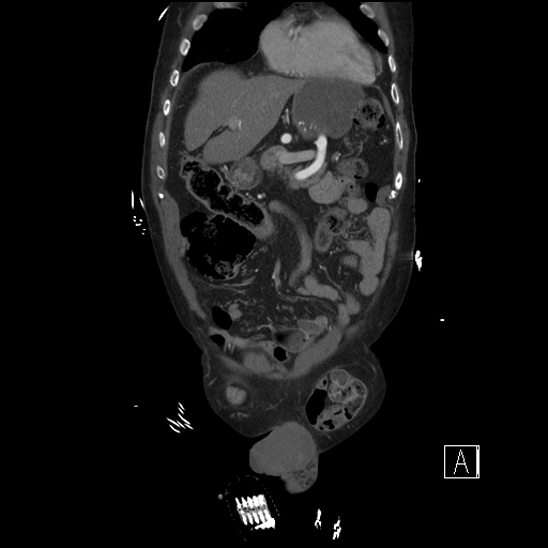 Aortic dissection (CTPA) (Radiopaedia 75506-86750 F 15).jpg