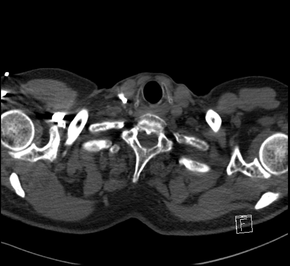 File:Aortic dissection (CTPA) (Radiopaedia 75506-86751 Axial C+ CTPA 3).jpg