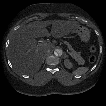 File:Aortic dissection (Radiopaedia 57969-64959 A 319).jpg