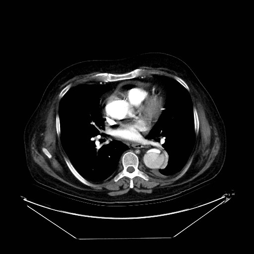 Aortic dissection (Radiopaedia 62562-71000 A 22).jpg